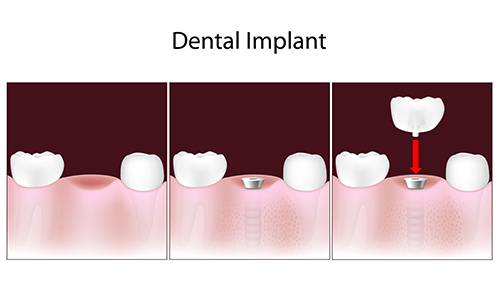dental implants 07417